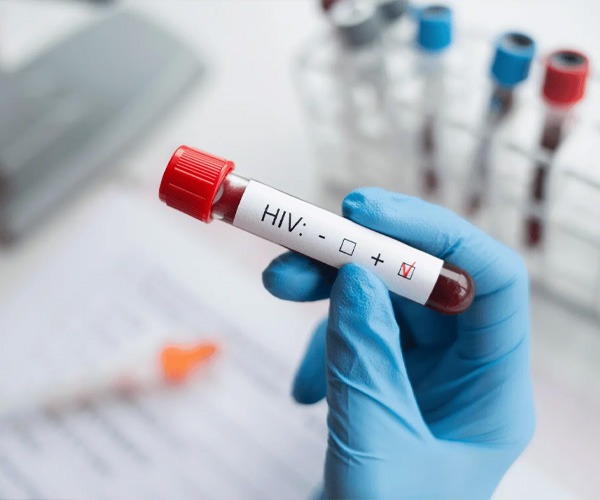 HIV test in uae