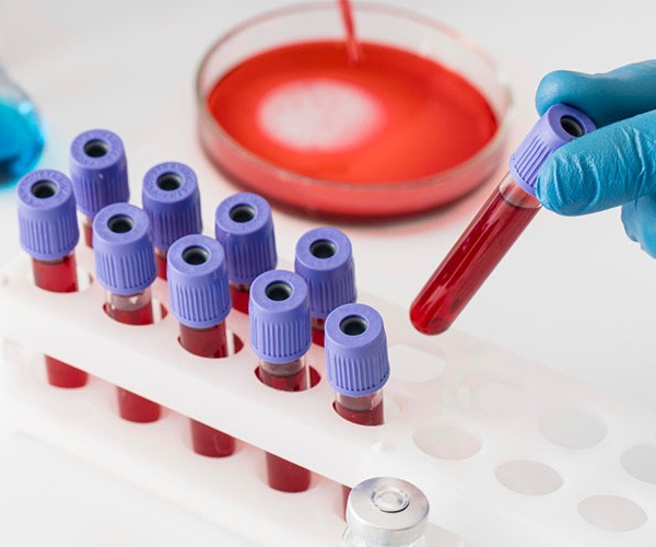 lipid profile test UAE